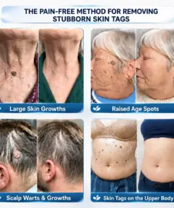 CureVivo® 𝟕-𝐃𝒂𝘆 𝐒𝗸𝐢𝐧 𝐓𝒂𝗴 & 𝐒𝐩𝙤𝐭 𝐄𝐫𝒂𝐬𝙚𝐫 Painless & Scar-Free Advanced Imperfection Remova𝗜 cream