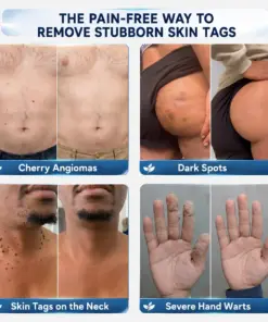 CureVivoยฎ ๐-๐๐๐ ๐๐ธ๐ข๐ง ๐๐๐ด & ๐๐ฉ๐ค๐ญ ๐๐ซ๐๐ฌ๐๐ซ Painless & Scar-Free Advanced Imperfection Remova๐ cream