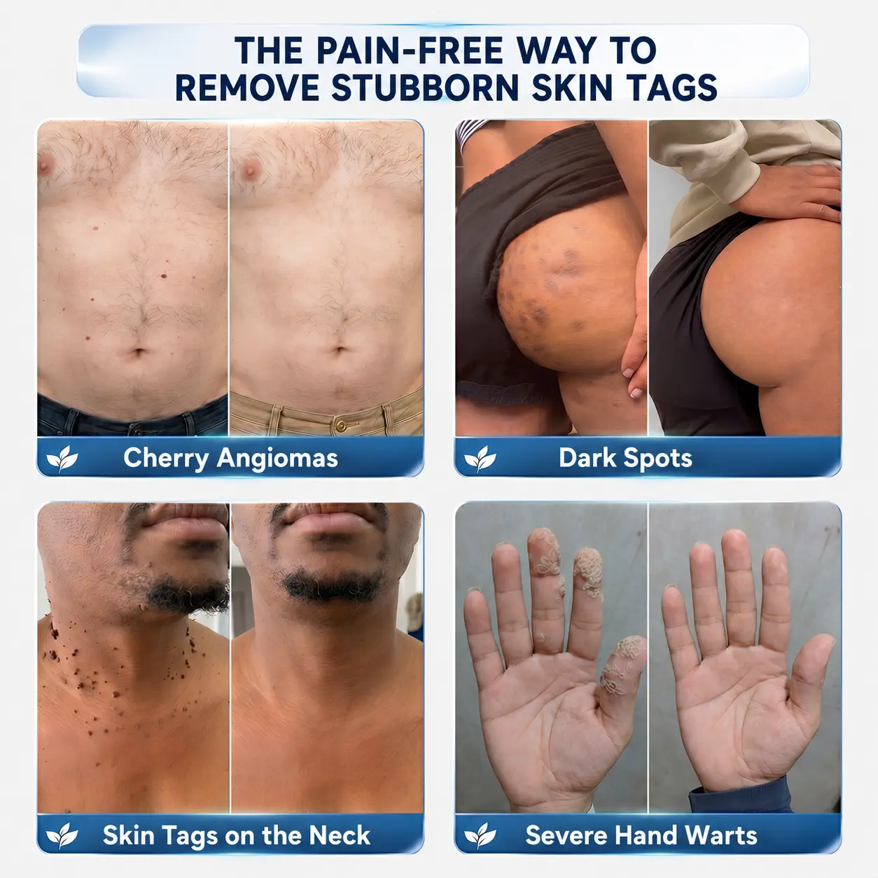 CureVivoยฎ ๐-๐๐๐ ๐๐ธ๐ข๐ง ๐๐๐ด & ๐๐ฉ๐ค๐ญ ๐๐ซ๐๐ฌ๐๐ซ Painless & Scar-Free Advanced Imperfection Remova๐ cream