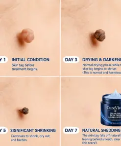 CureVivoยฎ ๐-๐๐๐ ๐๐ธ๐ข๐ง ๐๐๐ด & ๐๐ฉ๐ค๐ญ ๐๐ซ๐๐ฌ๐๐ซ Painless & Scar-Free Advanced Imperfection Remova๐ cream