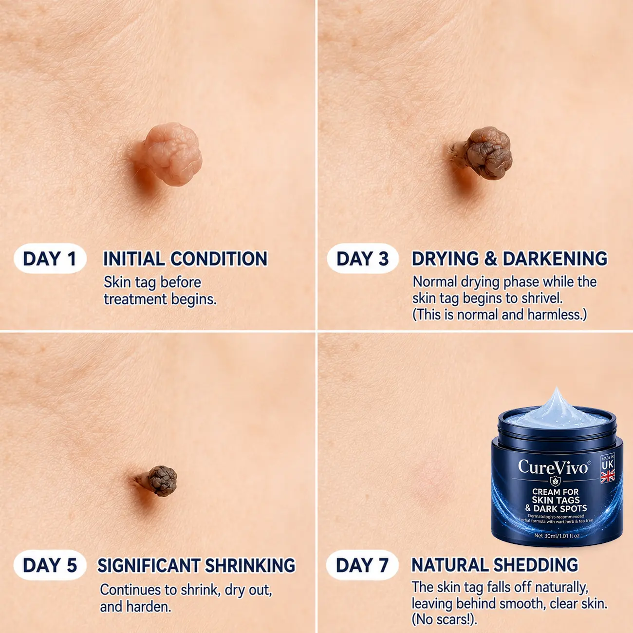 CureVivoยฎ ๐-๐๐๐ ๐๐ธ๐ข๐ง ๐๐๐ด & ๐๐ฉ๐ค๐ญ ๐๐ซ๐๐ฌ๐๐ซ Painless & Scar-Free Advanced Imperfection Remova๐ cream