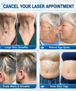 CureVivo® Skin Tag & Spot Eraser Cream
